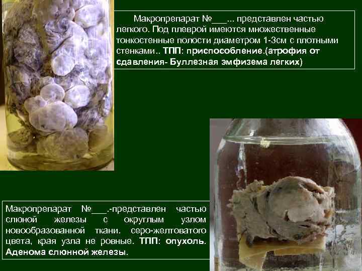 Макропрепарат №___. . . представлен частью легкого. Под плеврой имеются множественные тонкостенные полости диаметром