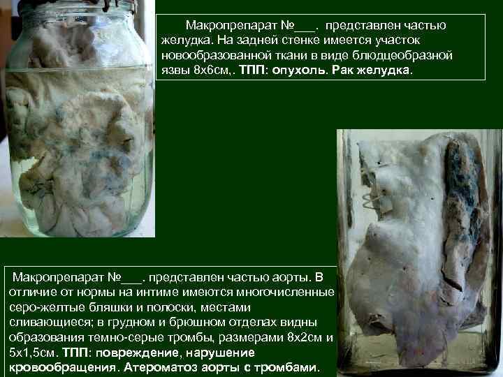 Макропрепарат №___. представлен частью желудка. На задней стенке имеется участок новообразованной ткани в виде