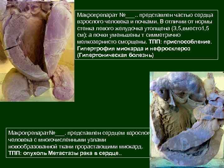 Макропрепарат №___. . представлен частью сердца взрослого человека и почками. В отличии от нормы