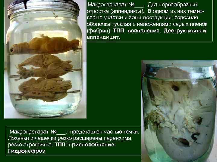 Макропрепарат №___. Два червеобразных отростка (аппендикса), В одном из них темносерые участки и зоны