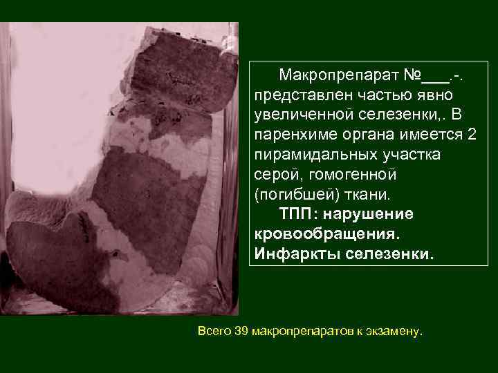 Макропрепарат №___. -. представлен частью явно увеличенной селезенки, . В паренхиме органа имеется 2