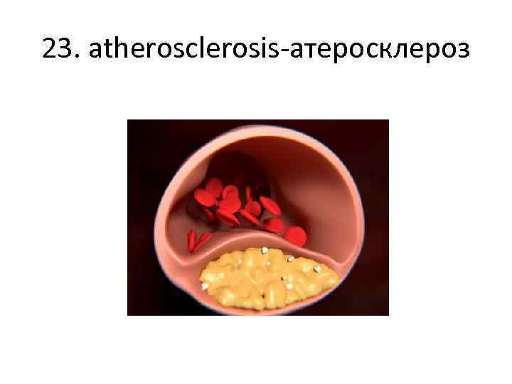 23. atherosclerosis-атеросклероз 