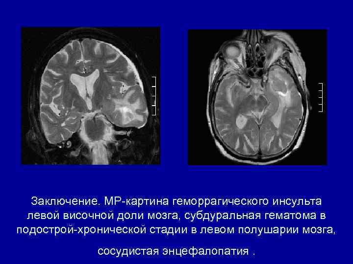 Заключение. МР-картина геморрагического инсульта левой височной доли мозга, субдуральная гематома в подострой-хронической стадии в
