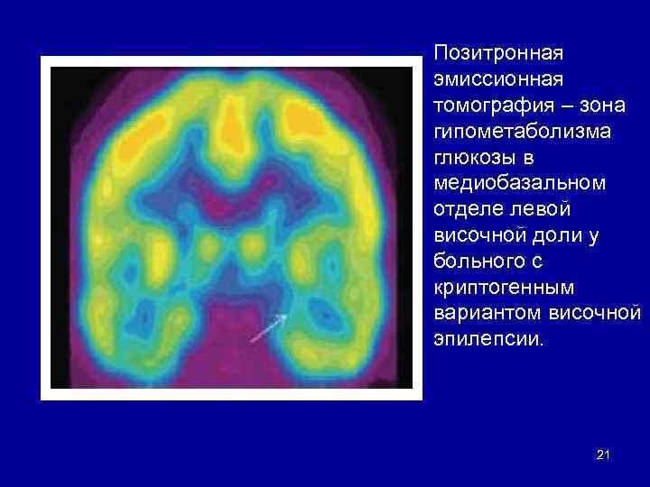 Позитронная эмиссионная томография – зона гипометаболизма глюкозы в медиобазальном отделе левой височной доли у