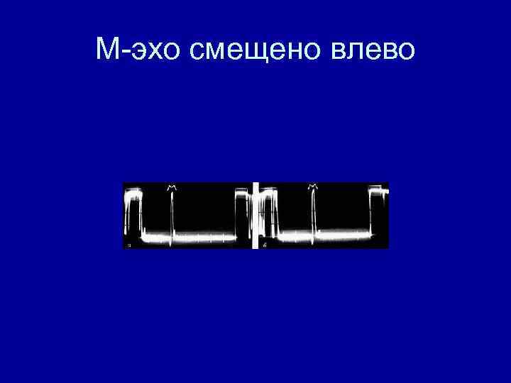 М-эхо смещено влево 