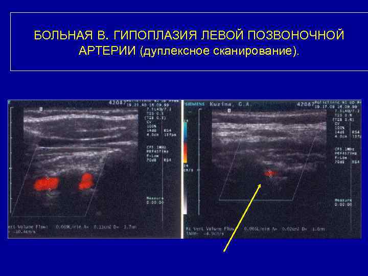 БОЛЬНАЯ В. ГИПОПЛАЗИЯ ЛЕВОЙ ПОЗВОНОЧНОЙ АРТЕРИИ (дуплексное сканирование). 