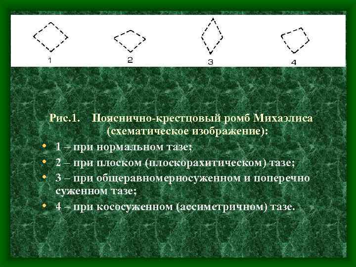 Рис. 1. Пояснично крестцовый ромб Михаэлиса (схематическое изображение): • 1 – при нормальном тазе;