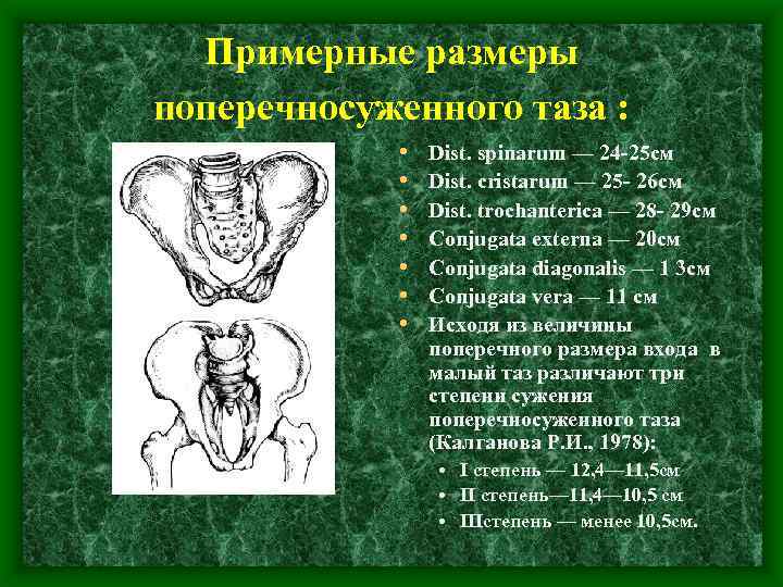 Презентация аномалии костного таза