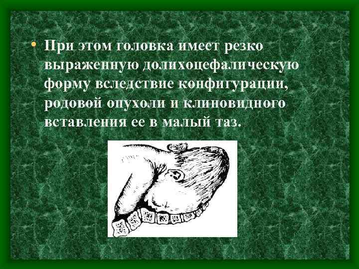  • При этом головка имеет резко выраженную долихоцефалическую форму вследствие конфигурации, родовой опухоли