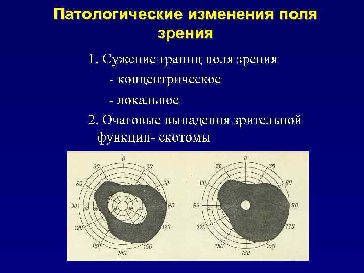 Патологические изменения поля зрения 1. Сужение границ поля зрения - концентрическое - локальное 2.