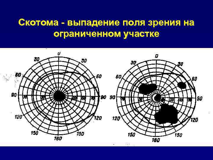 Скотома - выпадение поля зрения на ограниченном участке 