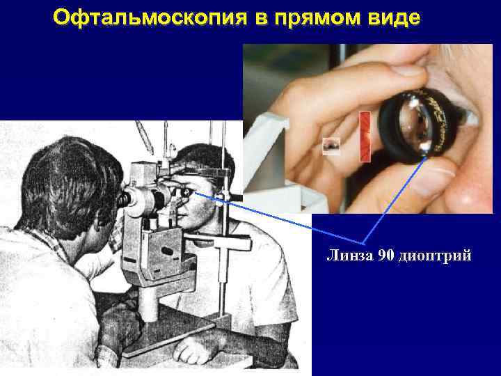 Офтальмоскопия линзой. Линза для осмотра глазного дна. Офтальмоскопия глазного дна. Прямая офтальмоскопия глазного дна. Осмотр глазного дна с линзой Гольдмана.