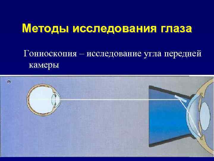 Методы исследования глаза Гониоскопия – исследование угла передней камеры 