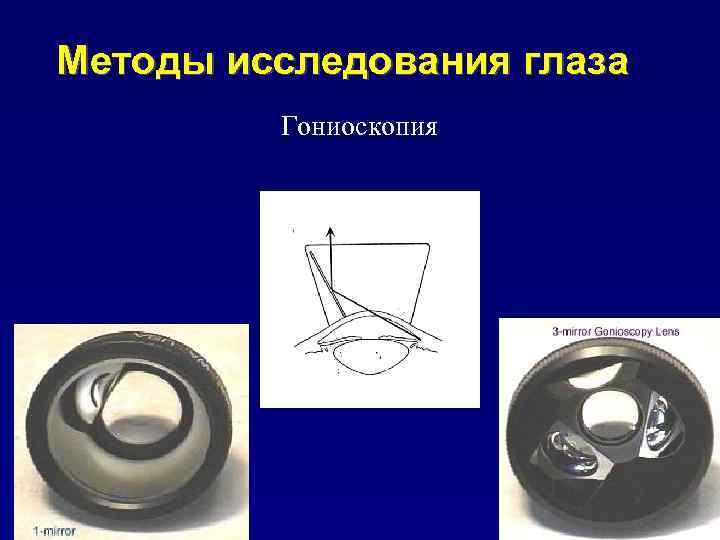 Методы исследования глаза Гониоскопия 