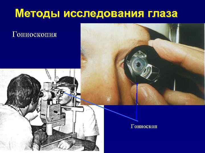 Методы исследования глаза Гониоскопия Гониоскоп 