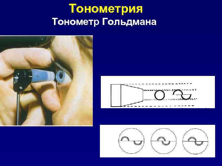 Тонометрия Тонометр Гольдмана 