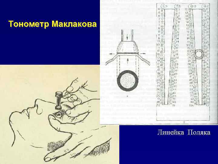 Тонометр Маклакова Линейка Поляка 