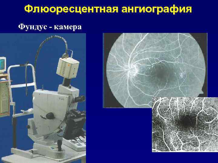 Флюоресцентная ангиография Фундус - камера 