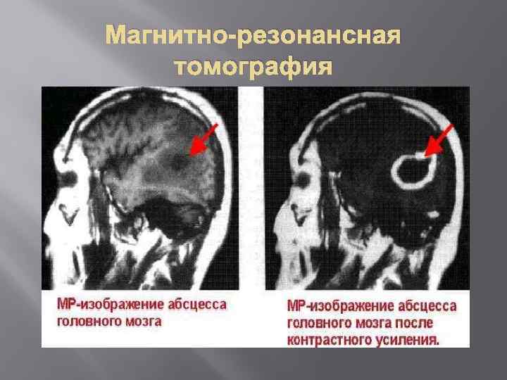 Магнитно-резонансная томография 