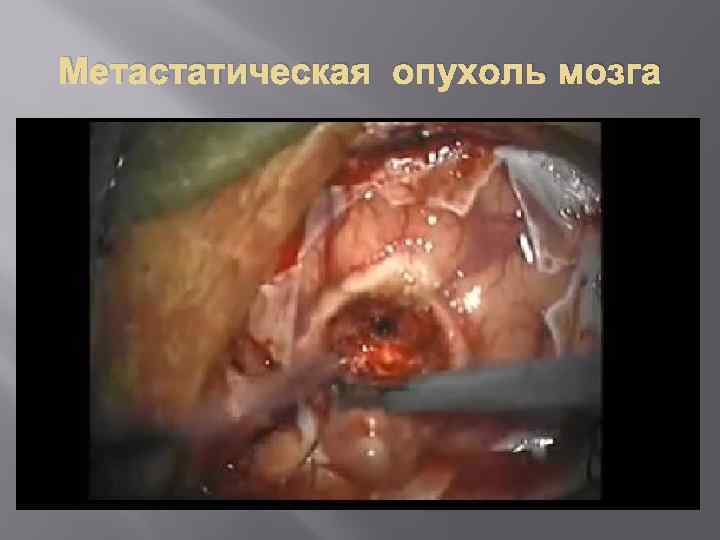 Метастатическая опухоль мозга 