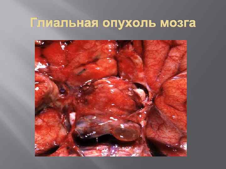 Глиальная опухоль мозга 