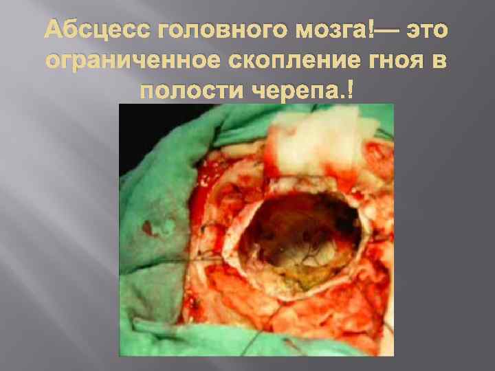 Абсцесс головного мозга — это ограниченное скопление гноя в полости черепа. 