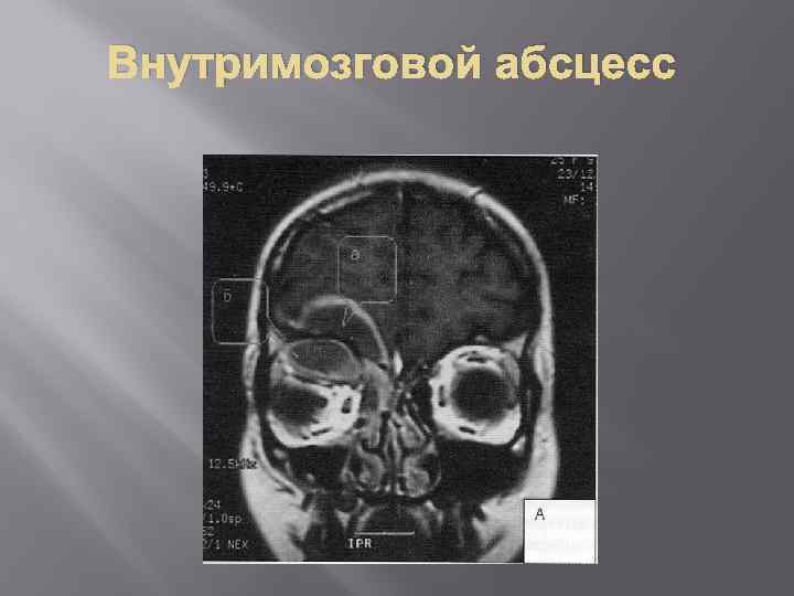 Внутримозговой абсцесс 