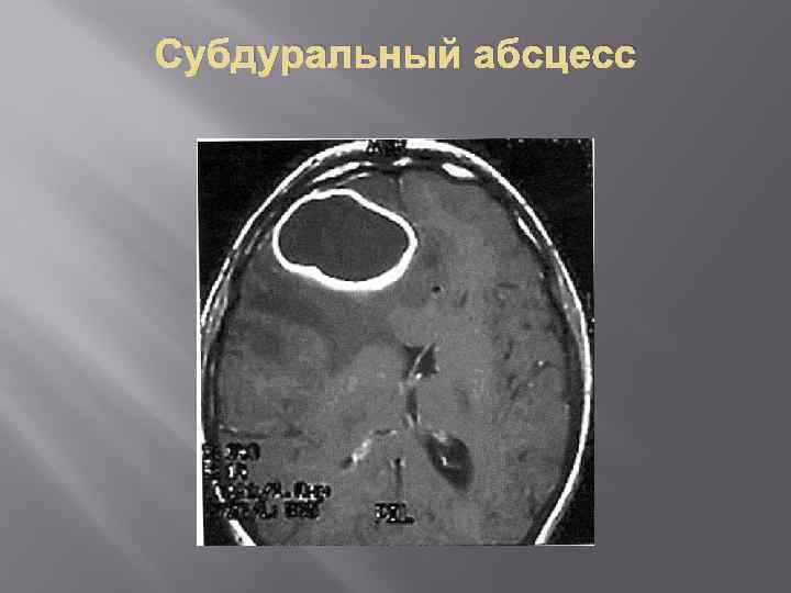 Субдуральный абсцесс 