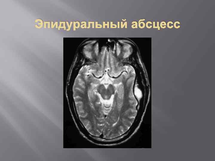 Эпидуральный абсцесс 