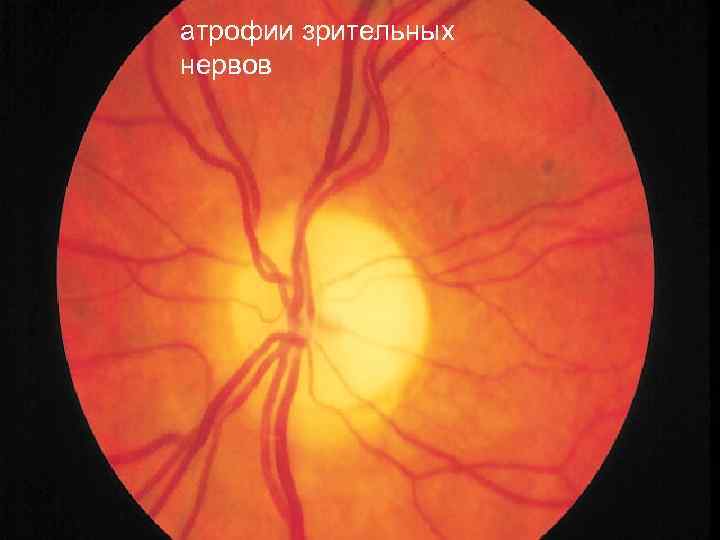 Аномалия развития зрительного нерва. Поражение хиазмы зрительного нерва. Наследственная атрофия зрительного нерва Лебера. Глиома диска зрительного нерва. Аномалии экскавации зрительного нерва.