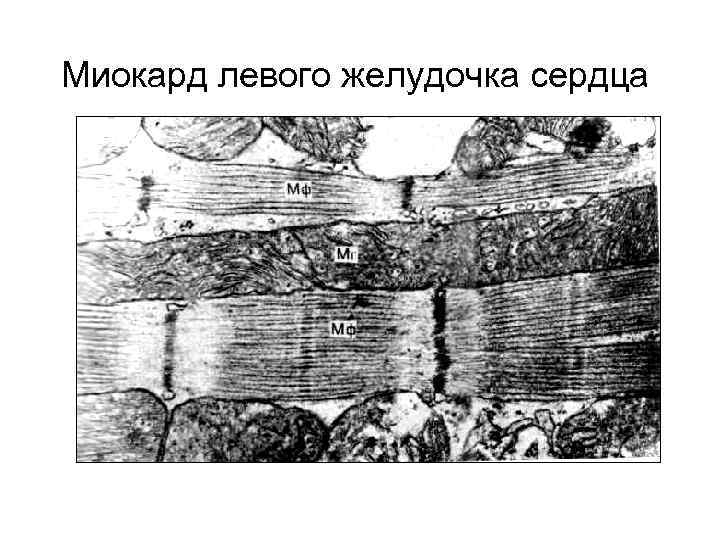 Миокард левого желудочка сердца 