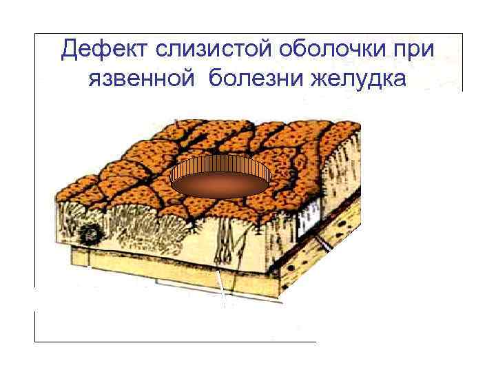 Дефект слизистой оболочки при язвенной болезни желудка 