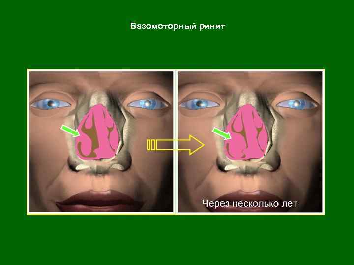 Вазомоторный ринит 