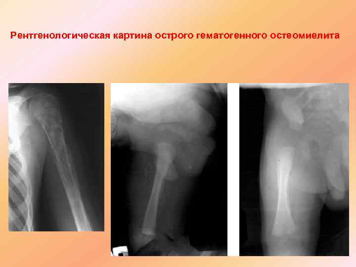 Рентгенологическая картина острого гематогенного остеомиелита 