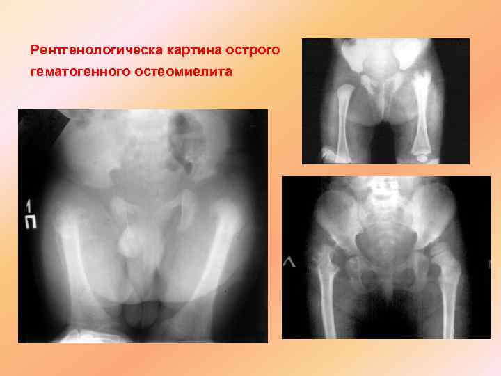 Рентгенологическа картина острого гематогенного остеомиелита 