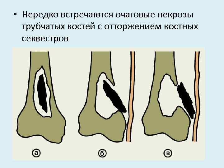  • Нередко встречаются очаговые некрозы трубчатых костей с отторжением костных секвестров 