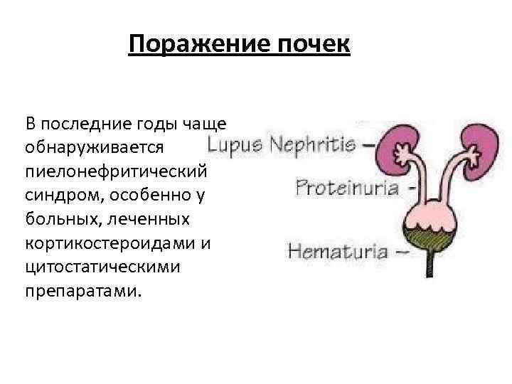 Поражение почек В последние годы чаще обнаруживается пиелонефритический синдром, особенно у больных, леченных кортикостероидами