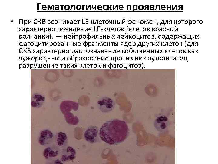 Гематологические проявления • При СКВ возникает LE клеточный феномен, для которого характерно появление LE