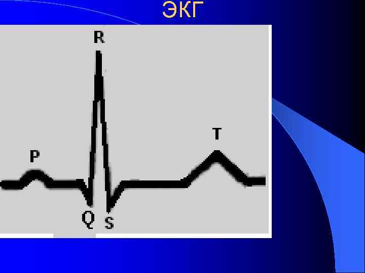 ЭКГ 