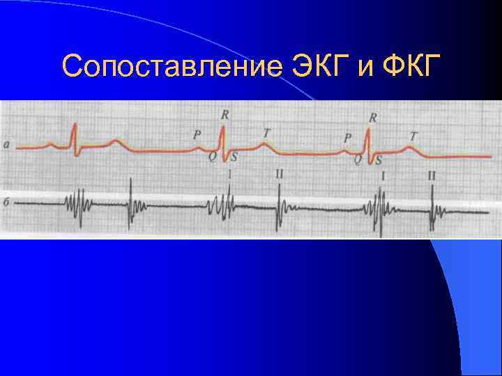 Сопоставление ЭКГ и ФКГ 