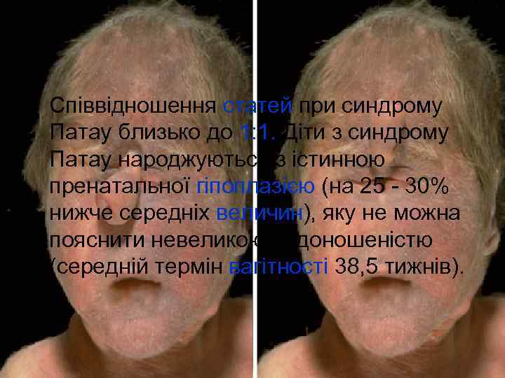 … • Співвідношення статей при синдрому Патау близько до 1: 1. Діти з синдрому