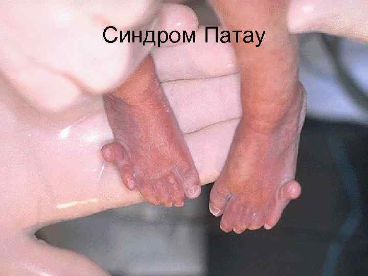 Синдром Патау 