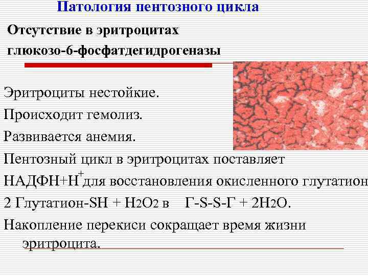 Патология пентозного цикла Отсутствие в эритроцитах глюкозо-6 -фосфатдегидрогеназы Эритроциты нестойкие. Происходит гемолиз. Развивается анемия.