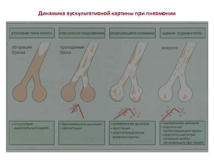 Динамика аускультативной картины при пневмонии 