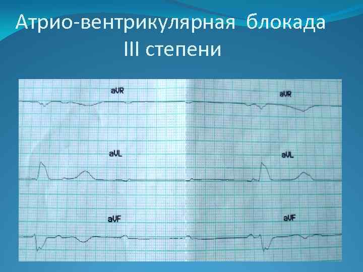 Атрио-вентрикулярная блокада III степени 