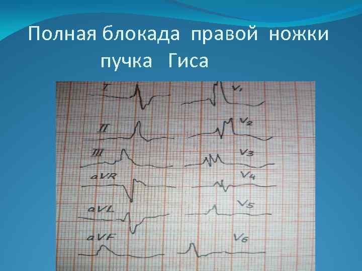 Полная блокада правой ножки гиса