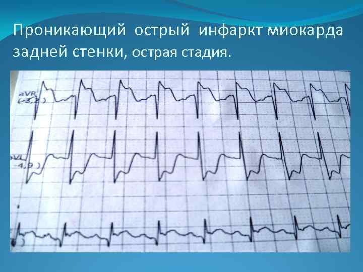 Проникающий острый инфаркт миокарда задней стенки, острая стадия. 