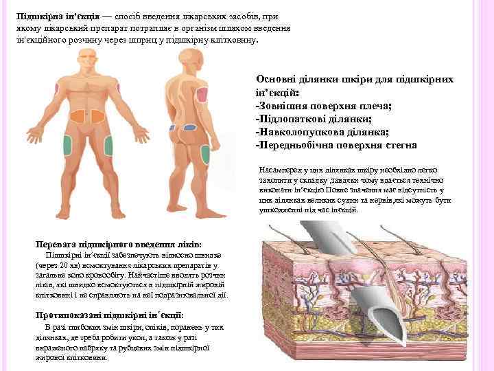 Підшкірна ін'єкція — спосіб введення лікарських засобів, при якому лікарський препарат потрапляє в організм