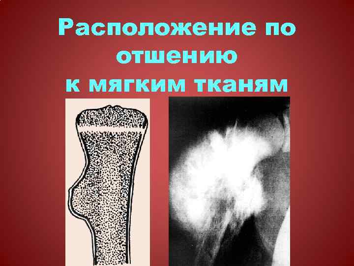 Расположение по отшению к мягким тканям 