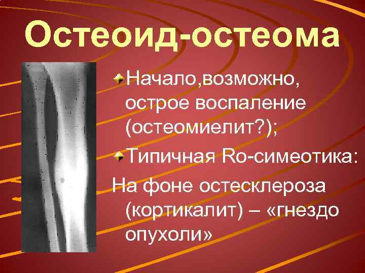 Остеоид-остеома Начало, возможно, острое воспаление (остеомиелит? ); Типичная Rо-симеотика: На фоне остесклероза (кортикалит) –